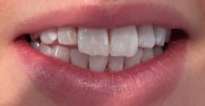 tooth veneers - before